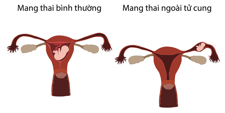 thai ngoài tử cung có nguy hiểm không