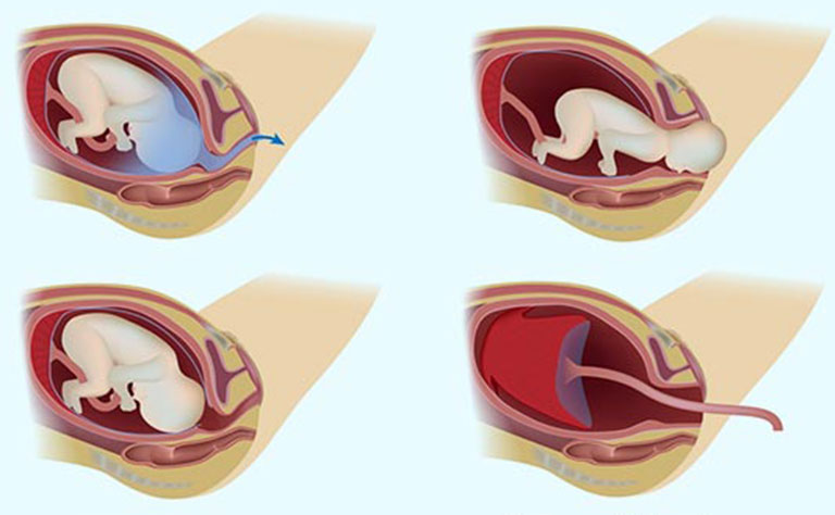 quá trình chuyển dạ sinh thường