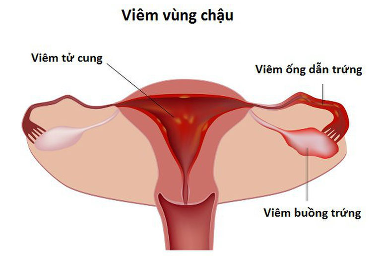 viêm vùng chậu có nguy hiểm không