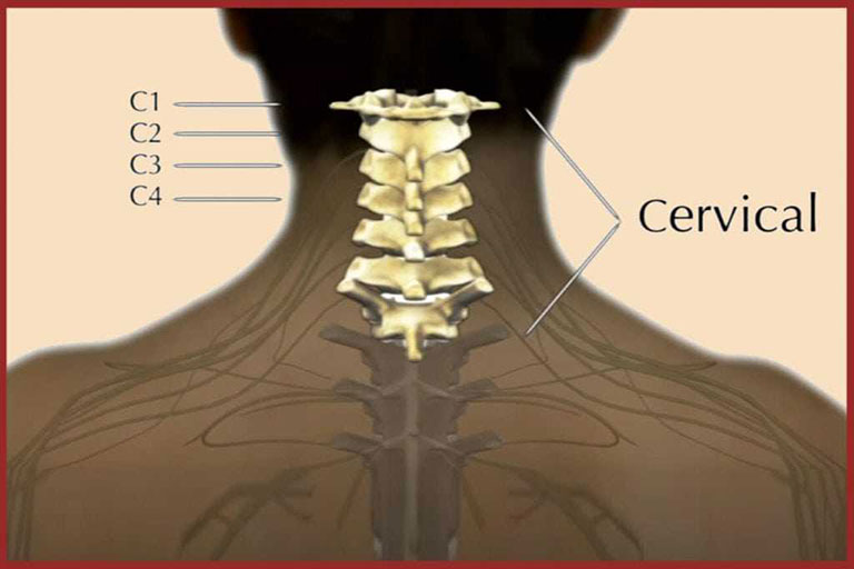 thoát vị đĩa đệm cổ