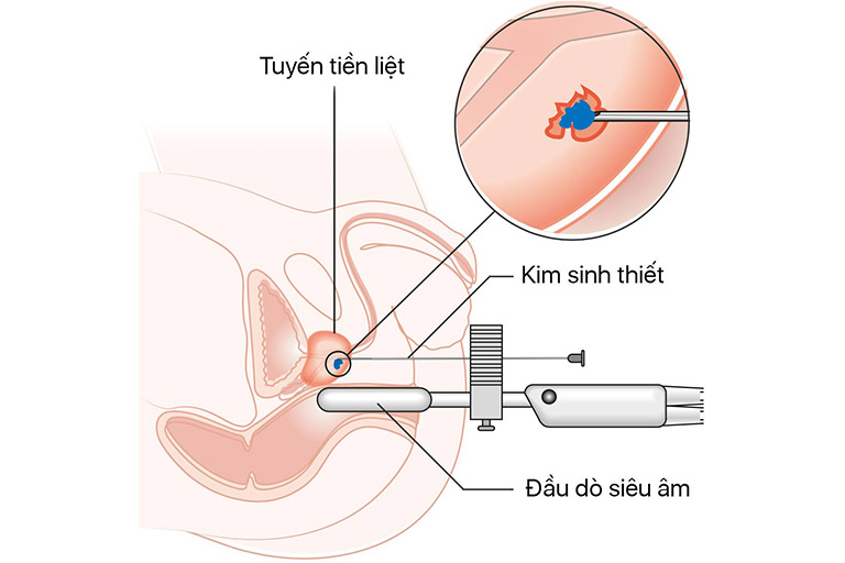 tinh trùng có máu là bệnh gì