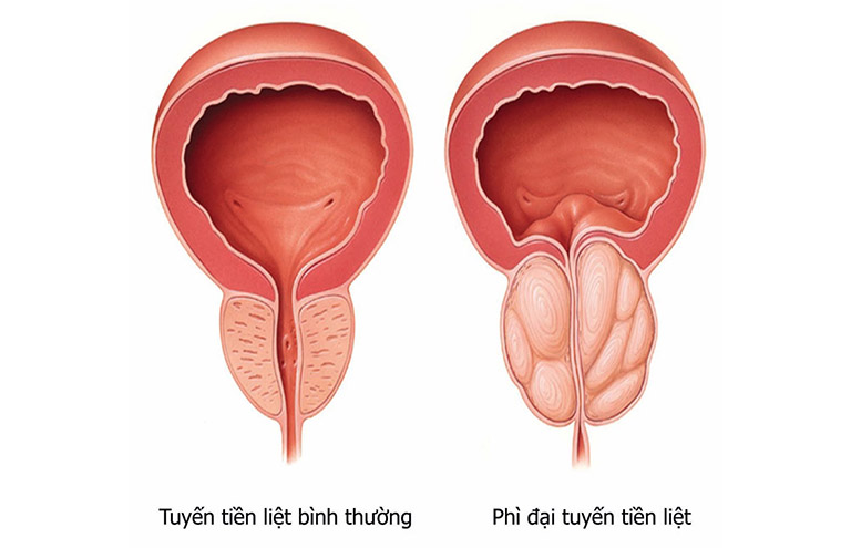 tinh trùng có máu là bệnh gì