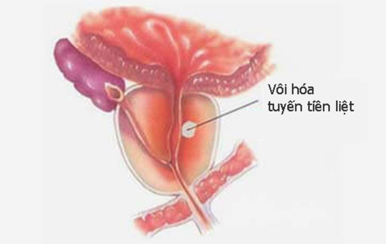 tinh trùng có máu là bệnh gì