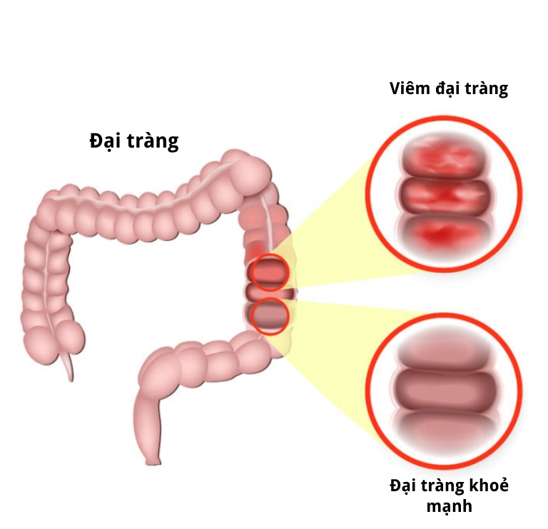 bệnh viêm đại tràng