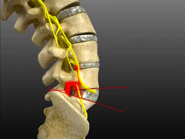 thoát vị đĩa đệm l5 s1 thể trung tâm