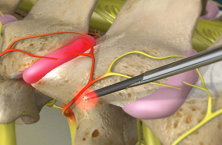 điều trị thoát vị đĩa đệm bằng sóng cao tần