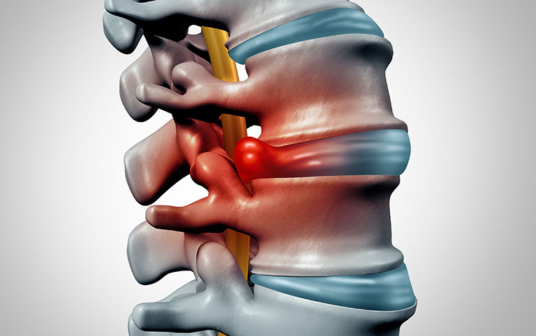 thoái hóa đĩa đệm cột sống thắt lưng