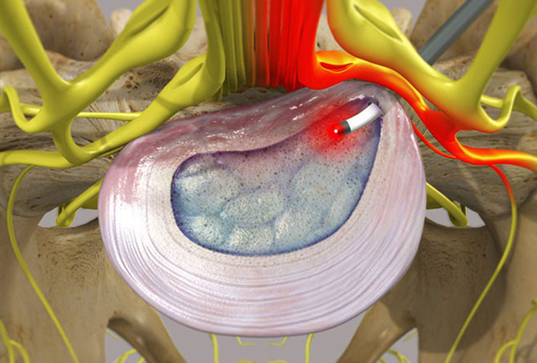 Điều trị thoát vị đĩa đệm bằng laser