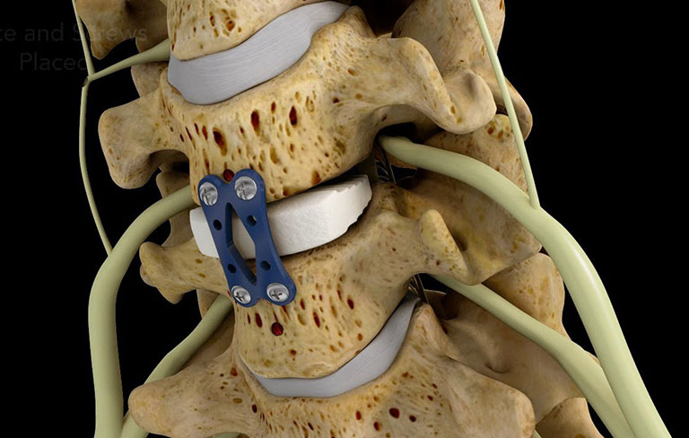 Phương pháp điều trị thoát vị đĩa đệm mới nhất