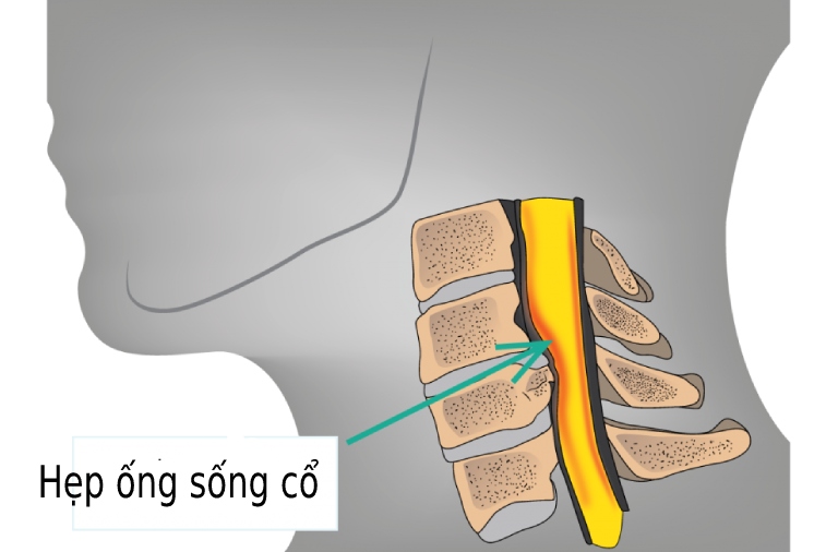 biến chứng thoát vị đĩa đệm cổ