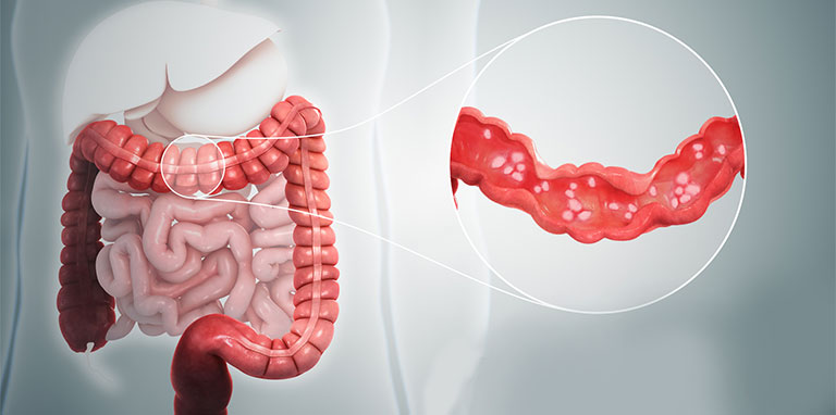 Các bệnh về đại tràng thường gặp - Crohn