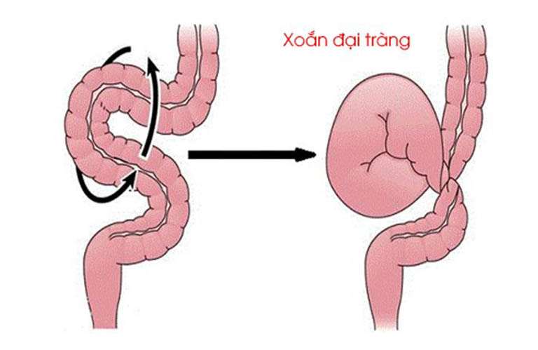 Các bệnh về đại tràng thường gặp - xoắn đại tràng