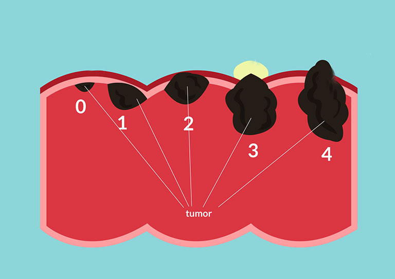 các giai đoạn của ung thư đại tràng