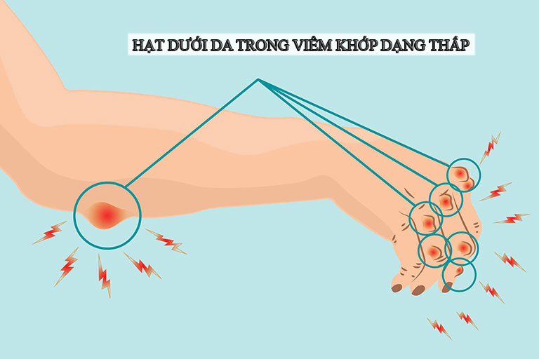 Hạt dưới da trong viêm khớp dạng thấp