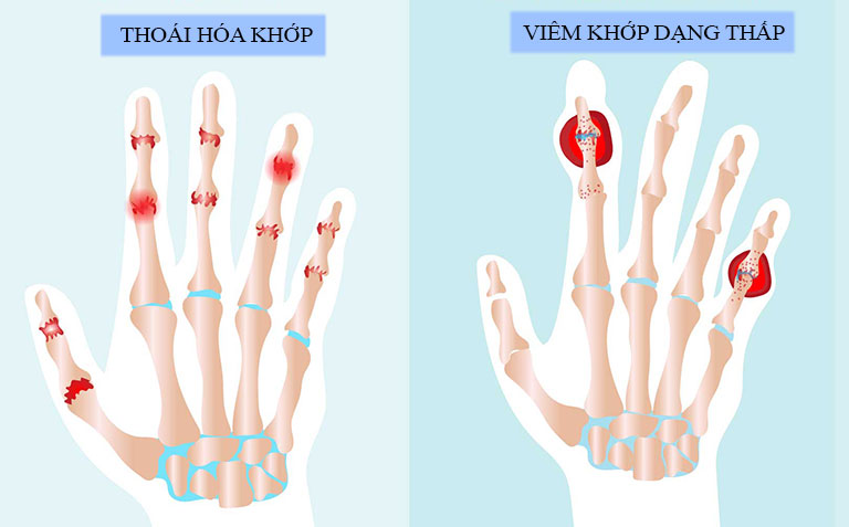 phân biệt viêm khớp dạng thấp và thoái hóa khớp