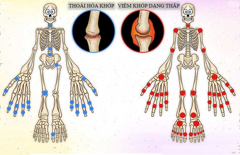 so sánh viêm khớp dạng thấp và thoái hóa khớp