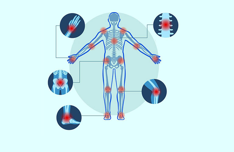 viêm khớp dạng thấp bệnh học