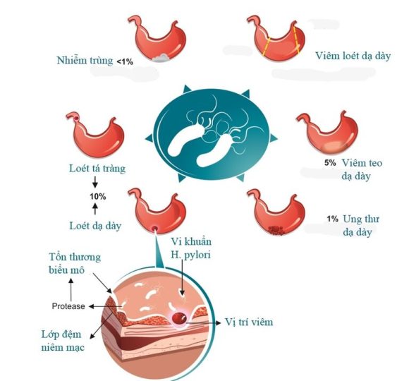 Vi khuẩn HP là nguyên nhân gây ra một loạt các vấn đề về dạ dày như viêm loét dạ dày, tá tràng