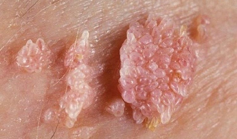 Sùi mào gà là  bệnh lây truyền qua đường tình dục (STD) phổ biến do virus HPV gây ra