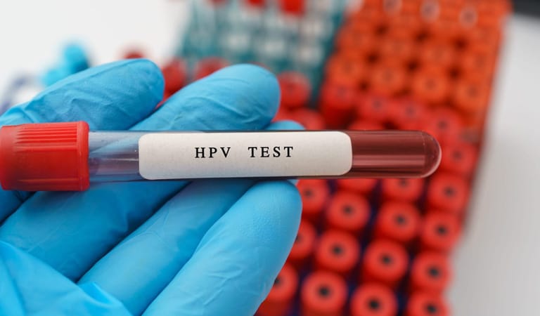 Xét nghiệm HPV là cách phát hiện bệnh nhanh và chính xác