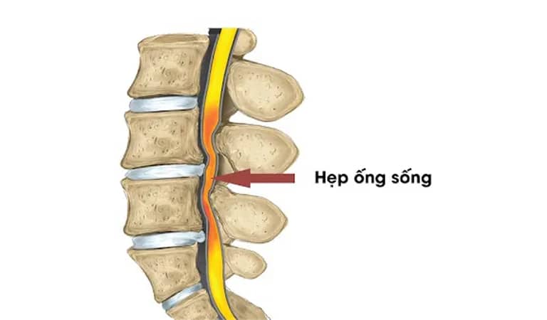 Biến chứng thoái hóa cột sống điển hình nhất là hẹp cột sống